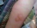 ampollas