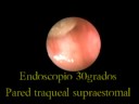 Obstructive Tracheal Granuloma
