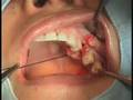 ExFeel Internal Live Surgery - 03