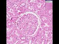 Histopathology Kidney --Systemic lupus erythematosus Histopathology Kidney --Systemic lupus erythematosus