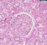 Histopathology Kidney --Systemic lupus erythematosus