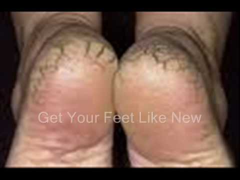 how to apply vtwo gel