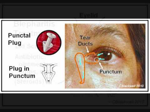 how to relieve dry eyes