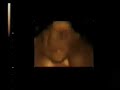 Baby Bea @ 26 weeks in utero 3d/4d Ultrasound