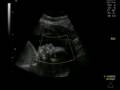 Baby Bea @ 26 weeks in utero 3d/4d Ultrasound