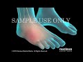 www.nucleusinc.com Esta animación médica en 3D describe cómo esta condición crónica causa dolor, inflamación y ardor persistentes en una o más de sus extremidades. Esta animación compara la respuesta de inflamación normal con la respuesta anormal causada por el Síndrome de dolor regional complejo/Distrofia simpática refleja (CRPS/RSD).
