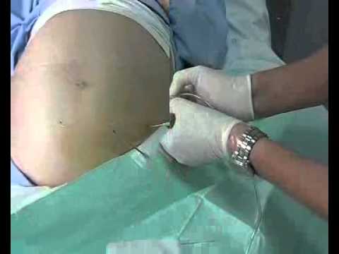 how to perform paracentesis