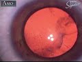 Cataract Extraction: Phacoemulsification