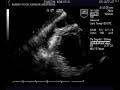TEE Pericardial Effusion