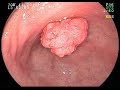 This is a procedue video from an upper endoscopy with the snare removal of a large gastric polyp in a lady with cirrhosis.