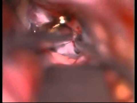 Previously Coiled Aneurysms Microsurgery - Experience on group of 81 patients - Video 2