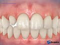 Lateral Incisor Build-Ups