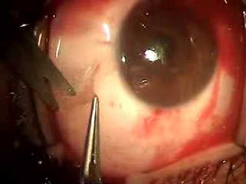 Pterygium+surgery