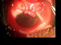 pterigyum-surgery-with-conjunctival-autograft.html