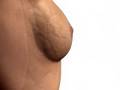 breast augmentation images