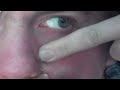 Zit popping