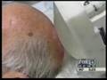 Hyperthermia Treatment of Skin Cancer Tumor