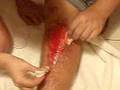 Phils manky leg