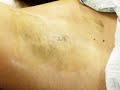 Hyperhidrosis Treatment with Botox