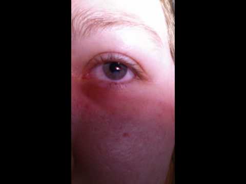how to relieve twitching eye