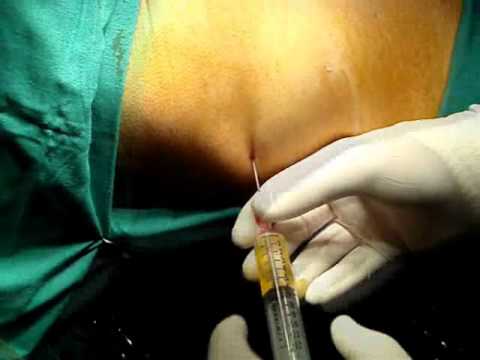 how to drain aspira catheter