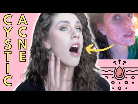 how to heal a cystic acne