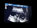 Ultrasound 2 5_19_2008 - YouTube