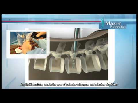 Mini robot (spine-assist) helpt bij hernia behandeling (Spondylodese)