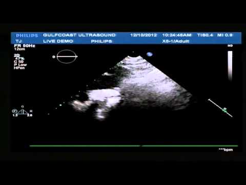how to measure aorta on ultrasound