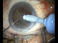 cirugia oftalmologia catarata facoemulsificacion cirugia oftalmologia catarata facoemulsificacion
