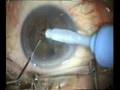 cirugia oftalmologia catarata facoemulsificacion