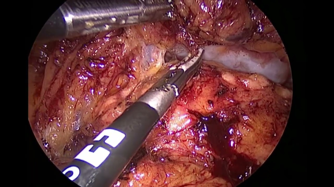 Local Advanced Transverse Colon Cancer - Laparoscopic Subtotal Colectomy