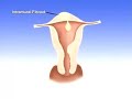 Uterine Fibroid Embolization