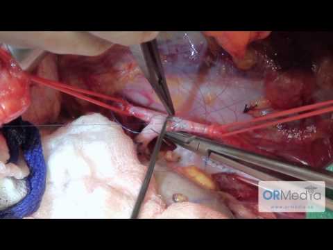 how to transplant kidney