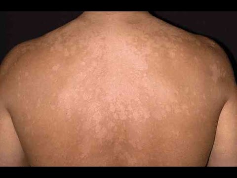 how to cure tinea versicolor