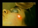 Dr. Steven Jepson talks about ActiveFx Fractional CO2 Laser Treatment Dr. Steven Jepson talks about ActiveFx Fractional CO2 Laser Treatment