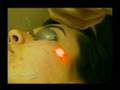 Dr. Steven Jepson talks about ActiveFx Fractional CO2 Laser Treatment