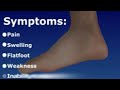 Introduction to Posterior Tibial Tendon Dysfunction