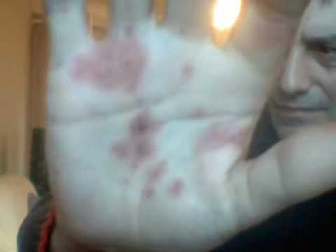 how to cure erythema multiforme