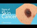 The Best 15 Skin Cancer Spots On Hands