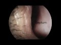 What a deviated nasal septum and enlarged turbinates look like