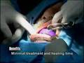 Teeth in an Hour Dental Implants-Dr. Moini-413.739.5685