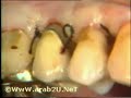 periodontal flap surgery 3