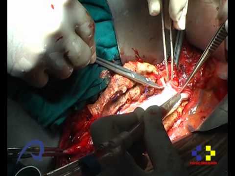 how to repair aortic aneurysm
