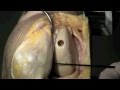 Cartilage Restoration Repair | Dr. Mark Wichman | Orthopaedics | Sports Medicine