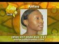 Operacion de la Nariz o Rinoplastia - Cirugia Estetica