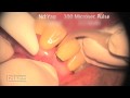 Laser Periodontal Surgery, Wavelength-optimized Periodontal Therapy (WPT) - Dr. Robert Barr