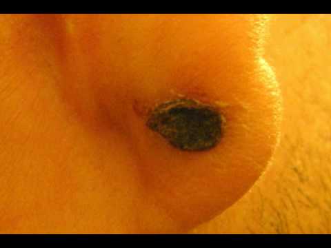 how to whiten keloid
