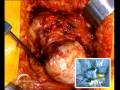 Birmingham Mid Head Resection (BMHR) Dysplasia Part 4