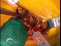 Birmingham Hip Resurfacing (BHR) by Derek McMinn Part 3